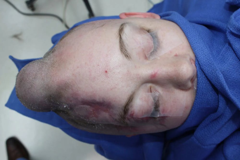 Facial and MOHS Reconstruction Before & After Gallery - Patient 5800822 - Image 13