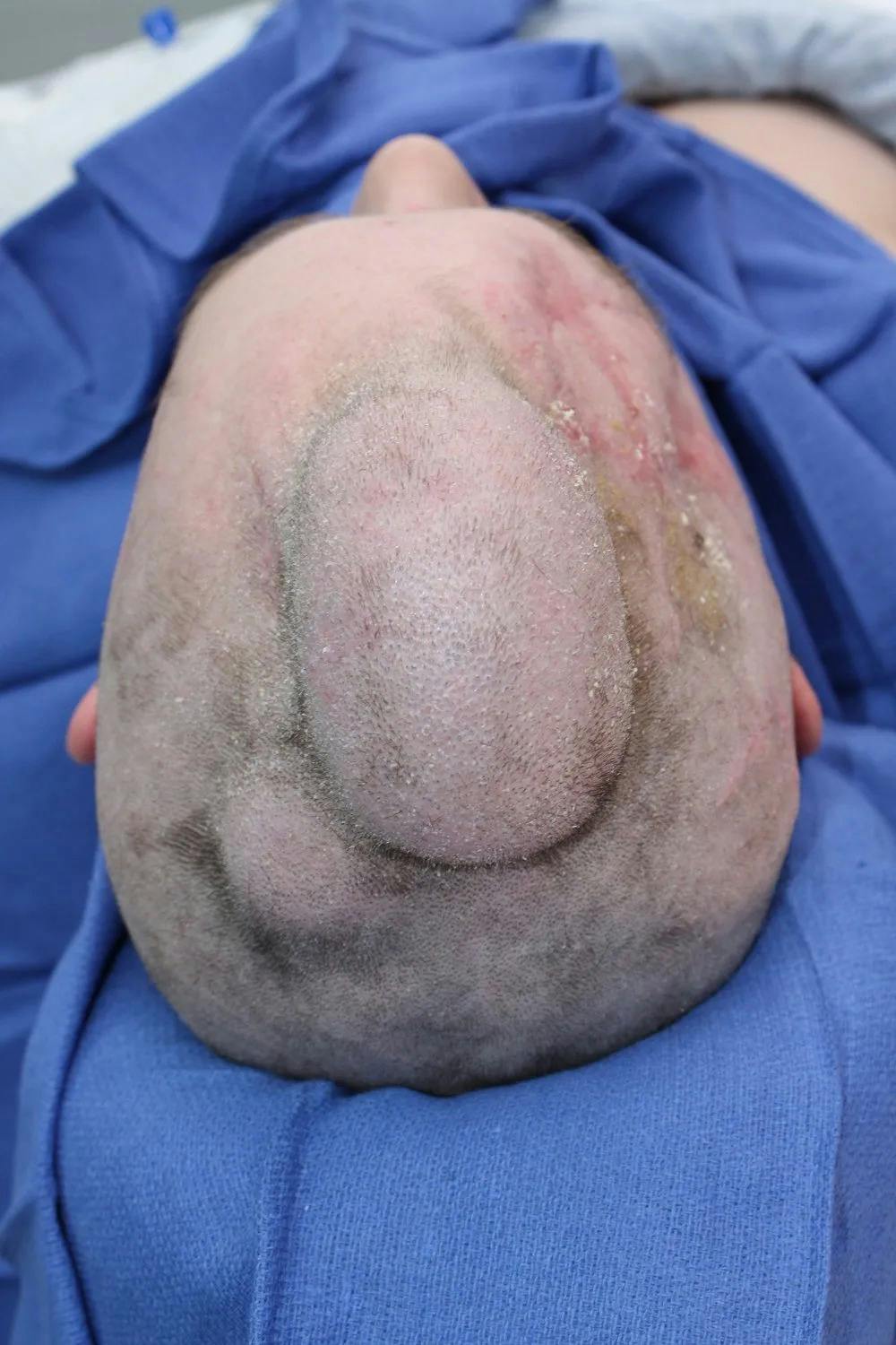 Facial and MOHS Reconstruction Before & After Gallery - Patient 5800822 - Image 14