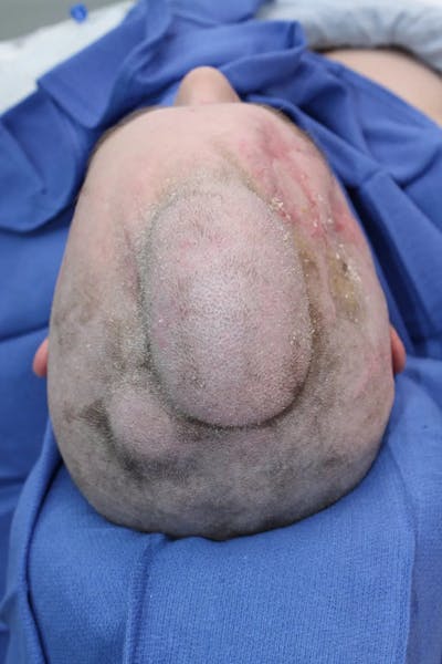 Facial and MOHS Reconstruction Before & After Gallery - Patient 5800822 - Image 14