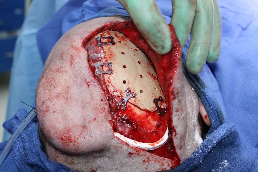 Facial and MOHS Reconstruction Before & After Gallery - Patient 5800822 - Image 17