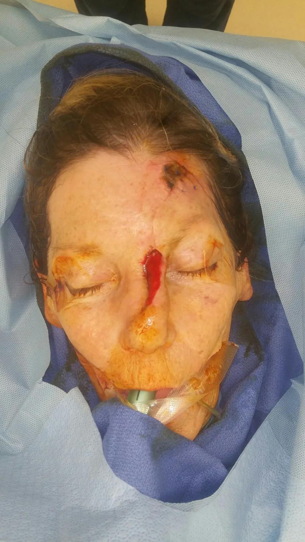 Facial and MOHS Reconstruction Before & After Gallery - Patient 5800823 - Image 3