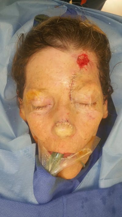 Facial and MOHS Reconstruction Before & After Gallery - Patient 5800823 - Image 4