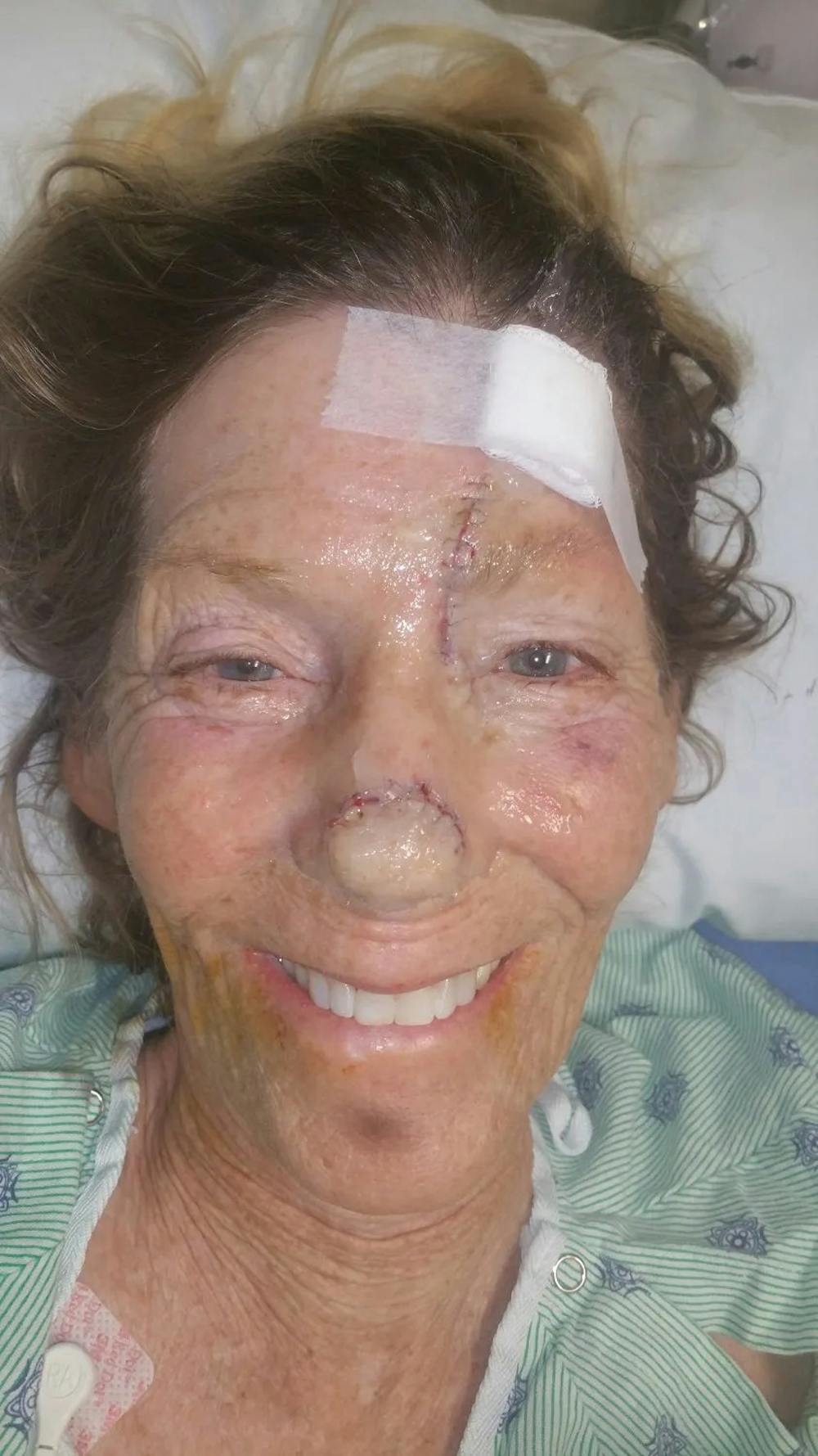 Facial and MOHS Reconstruction Before & After Gallery - Patient 5800823 - Image 5