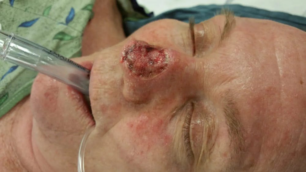 Facial and MOHS Reconstruction Before & After Gallery - Patient 5800824 - Image 1