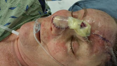 Facial and MOHS Reconstruction Before & After Gallery - Patient 5800824 - Image 2