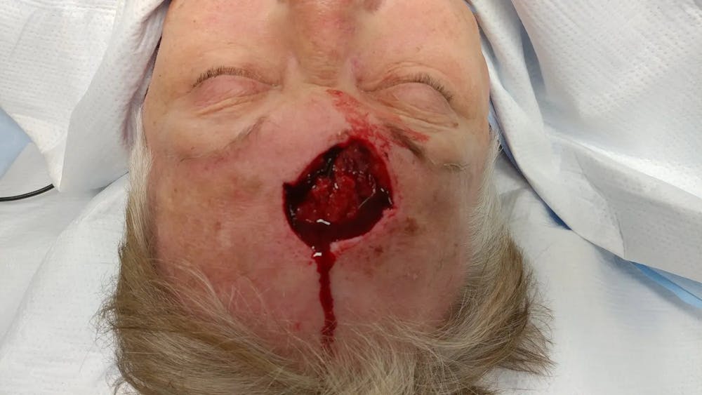 Facial and MOHS Reconstruction Before & After Gallery - Patient 5800825 - Image 1