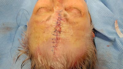 Facial and MOHS Reconstruction Before & After Gallery - Patient 5800825 - Image 2