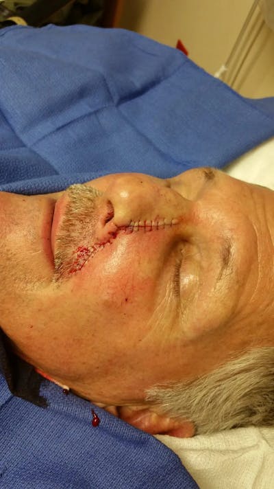 Facial and MOHS Reconstruction Before & After Gallery - Patient 5800828 - Image 2