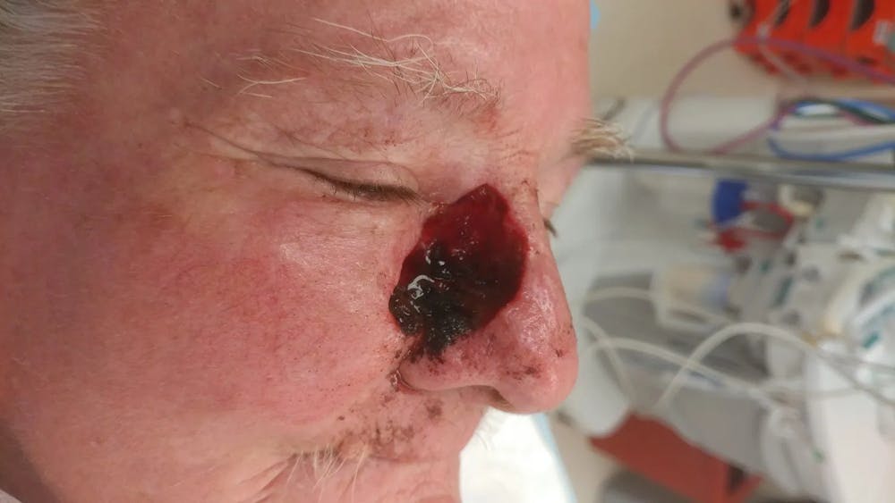 Facial and MOHS Reconstruction Before & After Gallery - Patient 5800829 - Image 2