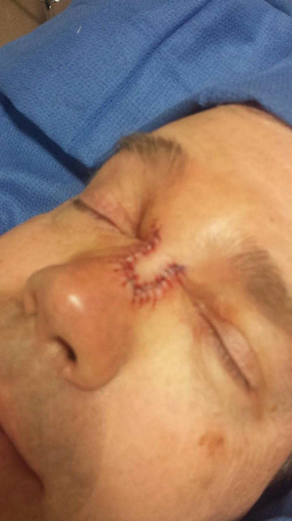 Facial and MOHS Reconstruction Before & After Gallery - Patient 5800830 - Image 2