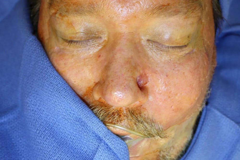 Facial and MOHS Reconstruction Before & After Gallery - Patient 5800831 - Image 1