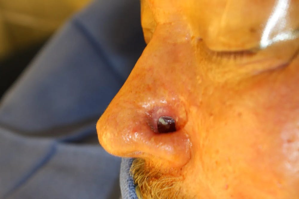 Facial and MOHS Reconstruction Before & After Gallery - Patient 5800831 - Image 2