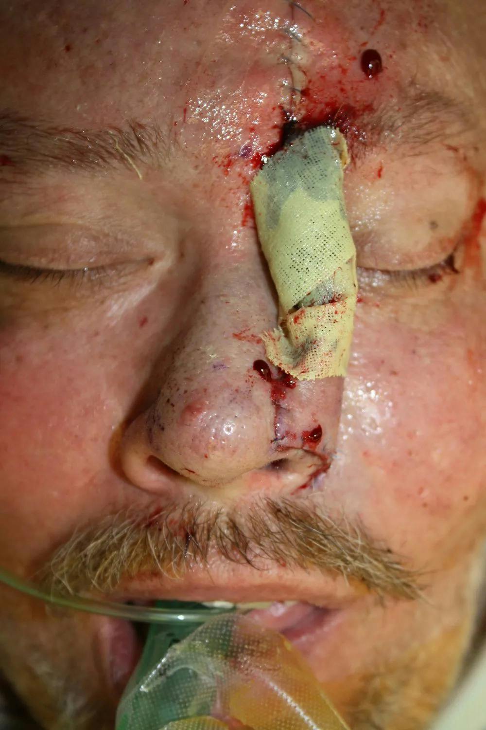 Facial and MOHS Reconstruction Before & After Gallery - Patient 5800831 - Image 3