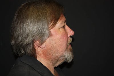 Facial and MOHS Reconstruction Before & After Gallery - Patient 5800831 - Image 8