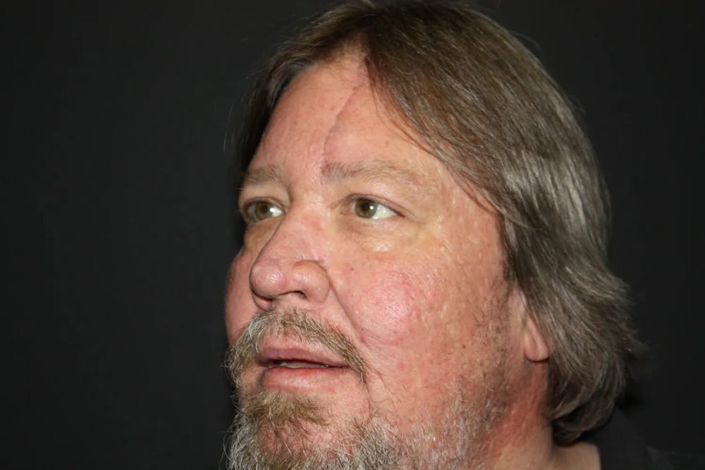 Facial and MOHS Reconstruction Before & After Gallery - Patient 5800831 - Image 9