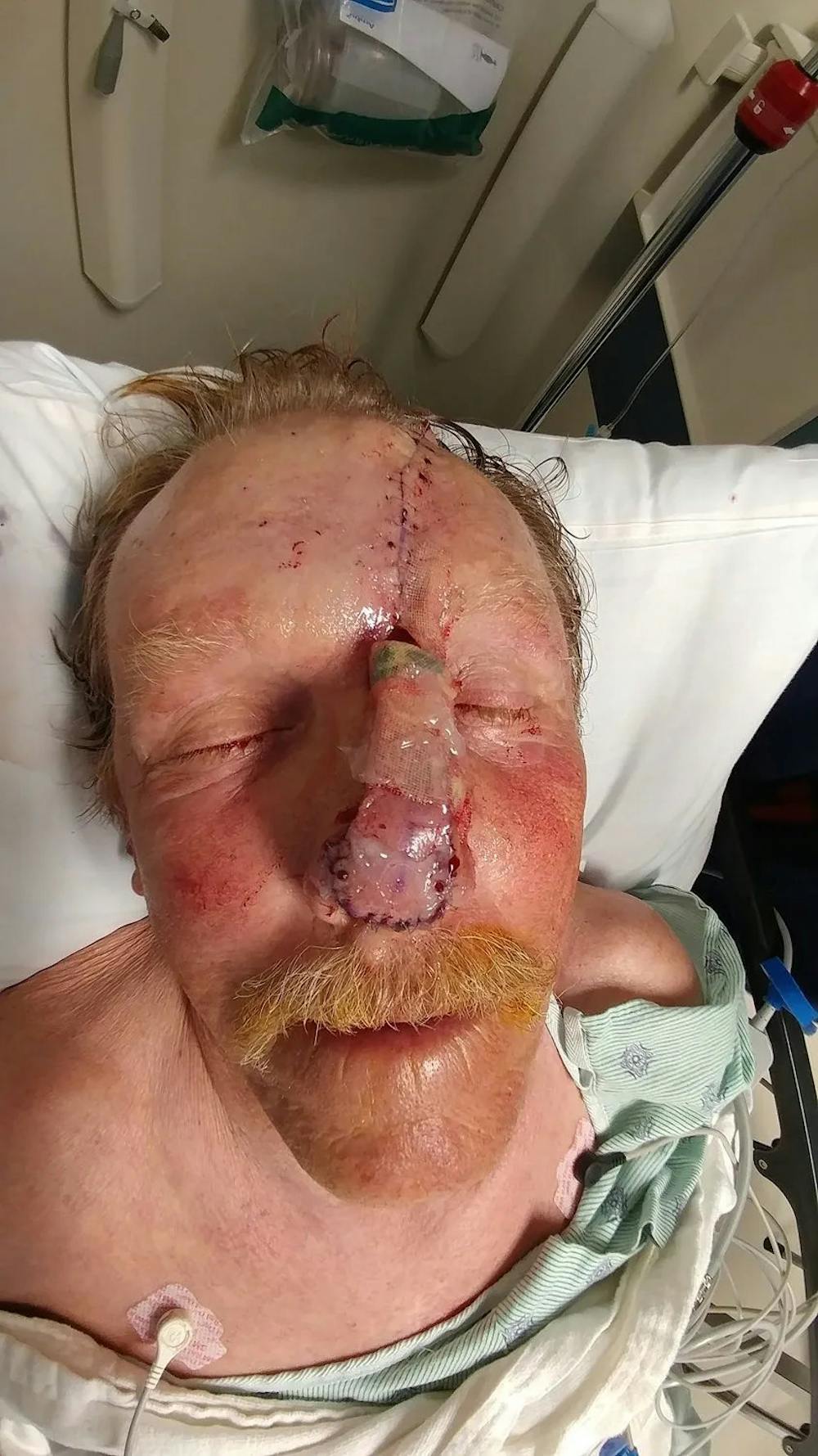 Facial and MOHS Reconstruction Before & After Gallery - Patient 5800832 - Image 2