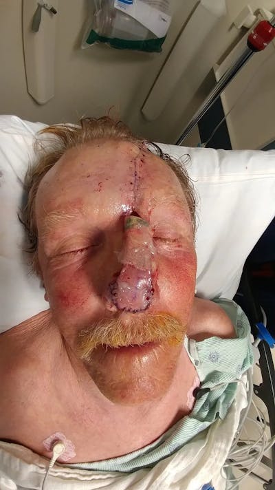 Facial and MOHS Reconstruction Before & After Gallery - Patient 5800832 - Image 2