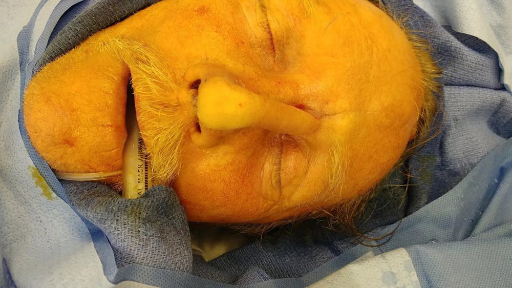 Facial and MOHS Reconstruction Before & After Gallery - Patient 5800832 - Image 4