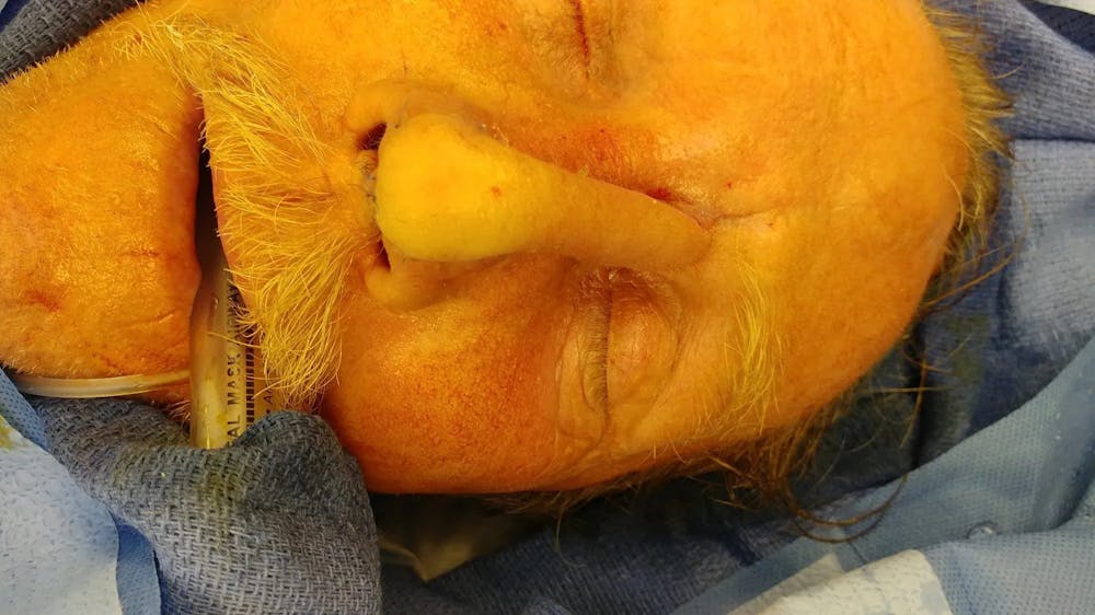 Facial and MOHS Reconstruction Before & After Gallery - Patient 5800832 - Image 5