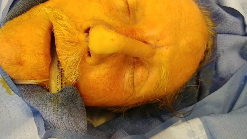 Facial and MOHS Reconstruction Before & After Gallery - Patient 5800832 - Image 6