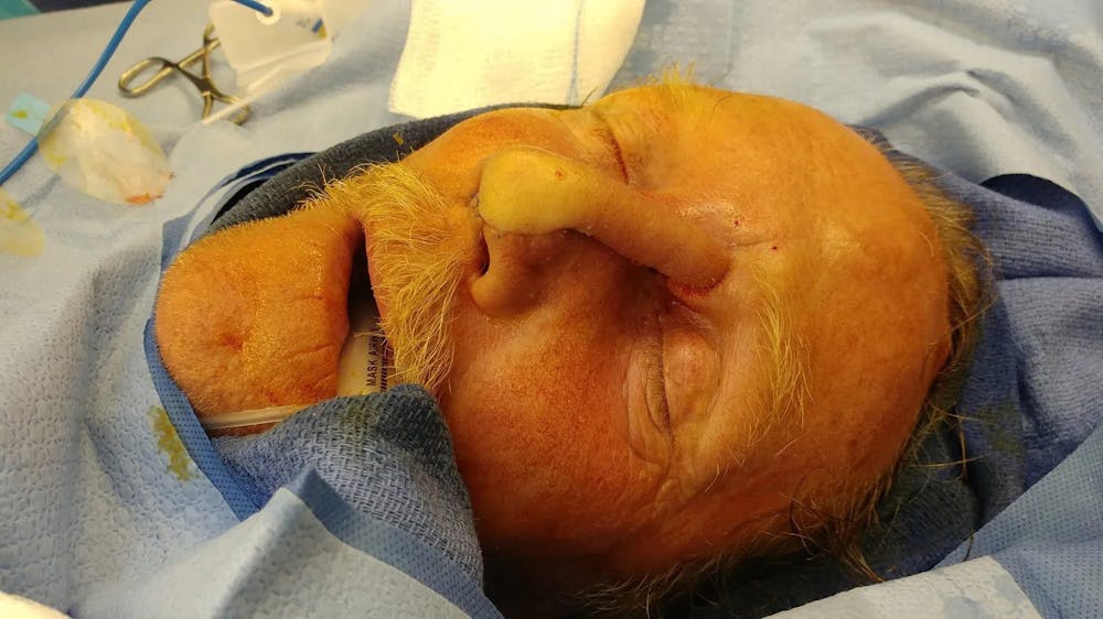 Facial and MOHS Reconstruction Before & After Gallery - Patient 5800832 - Image 7