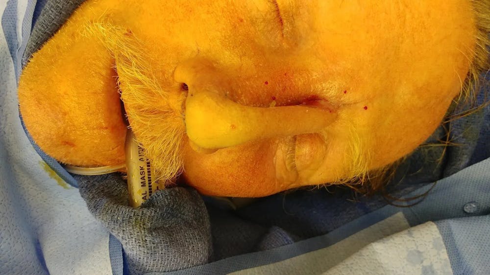 Facial and MOHS Reconstruction Before & After Gallery - Patient 5800832 - Image 8