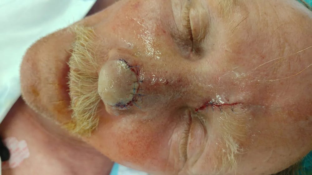 Facial and MOHS Reconstruction Before & After Gallery - Patient 5800832 - Image 10