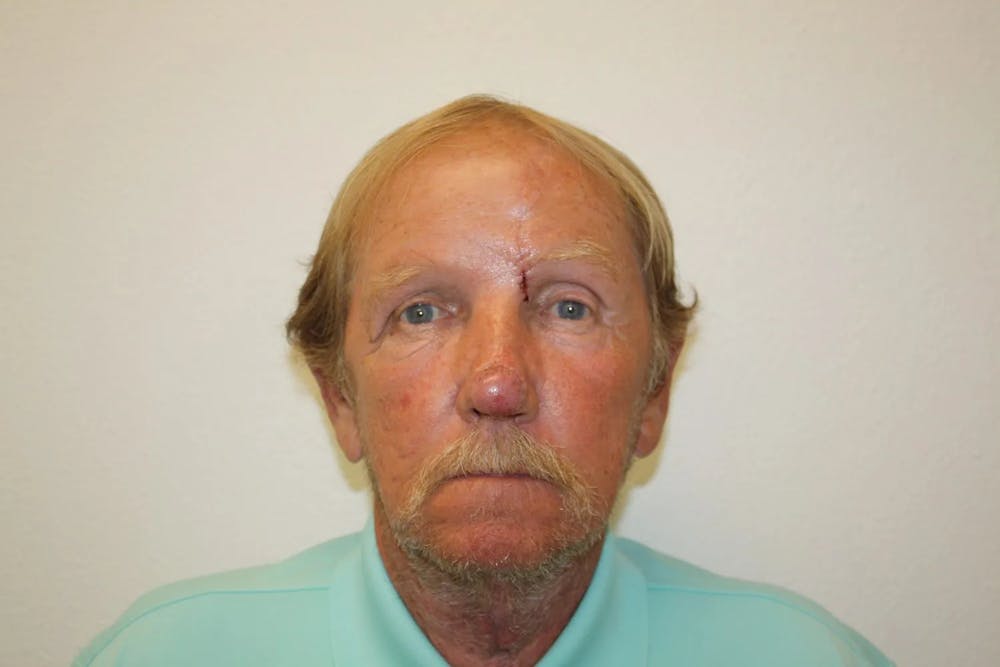 Facial and MOHS Reconstruction Before & After Gallery - Patient 5800832 - Image 11