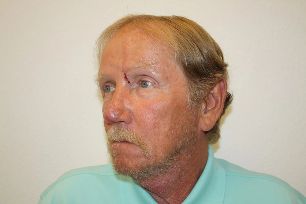 Facial and MOHS Reconstruction Before & After Gallery - Patient 5800832 - Image 12
