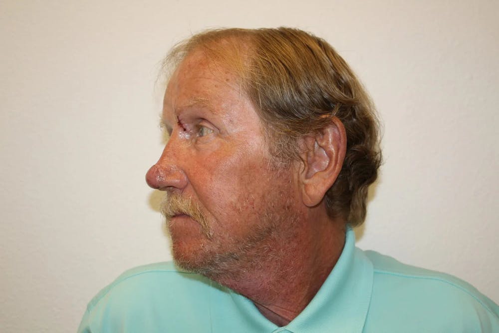 Facial and MOHS Reconstruction Before & After Gallery - Patient 5800832 - Image 13