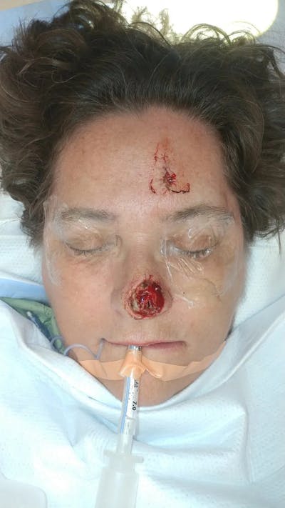 Facial and MOHS Reconstruction Before & After Gallery - Patient 5800833 - Image 1