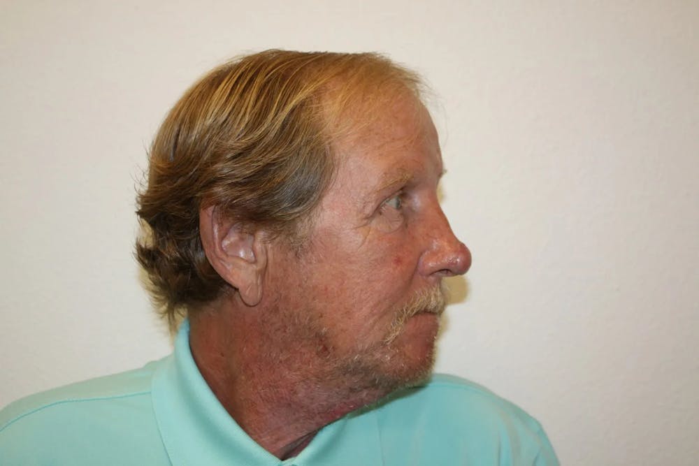 Facial and MOHS Reconstruction Before & After Gallery - Patient 5800832 - Image 15