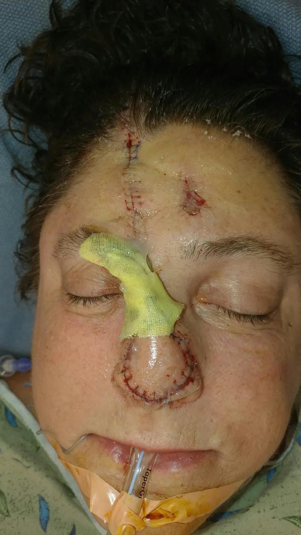 Facial and MOHS Reconstruction Before & After Gallery - Patient 5800833 - Image 2