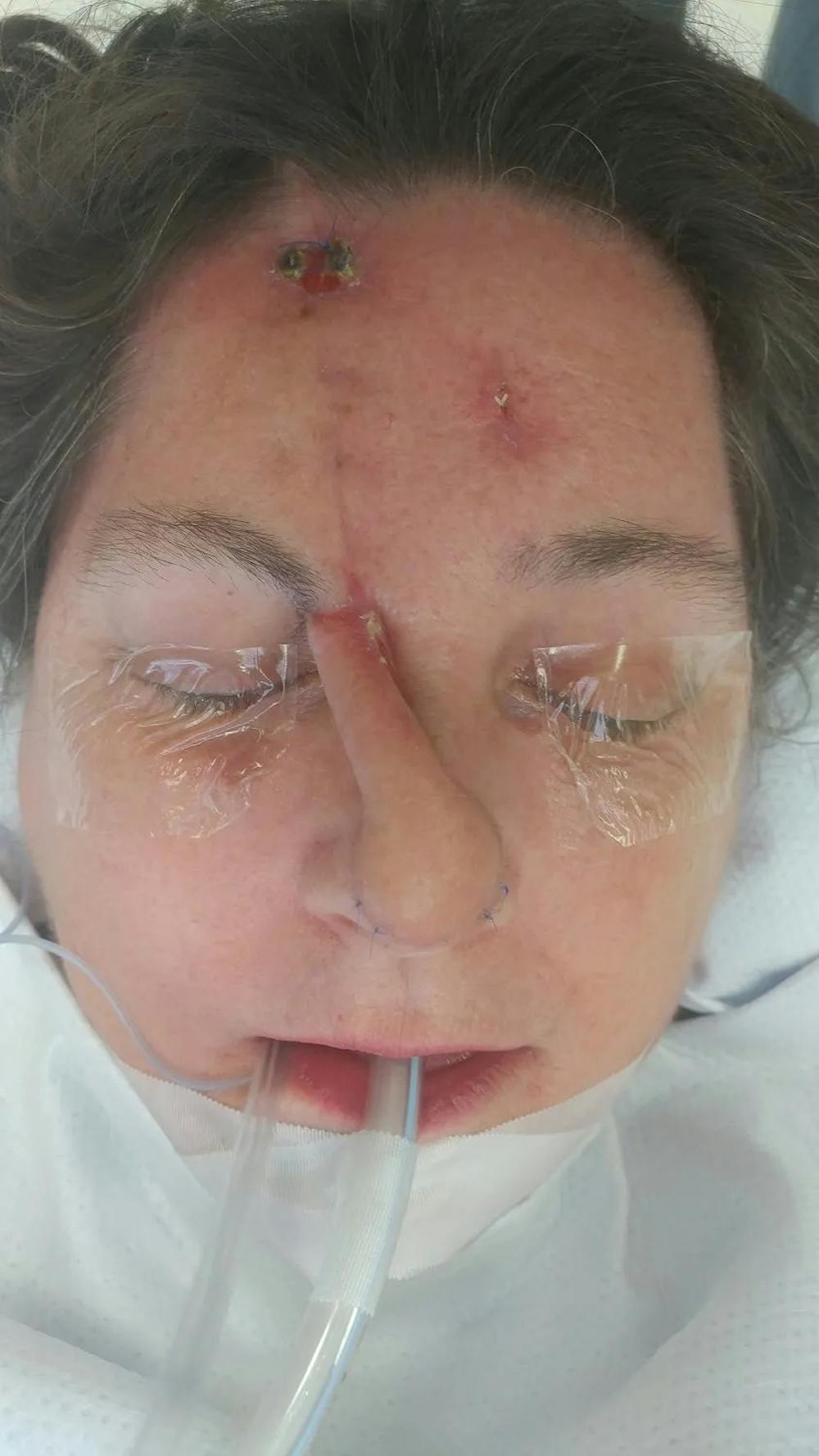 Facial and MOHS Reconstruction Before & After Gallery - Patient 5800833 - Image 3