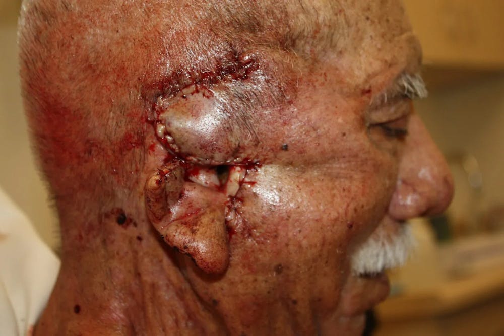 Facial and MOHS Reconstruction Before & After Gallery - Patient 5800834 - Image 2