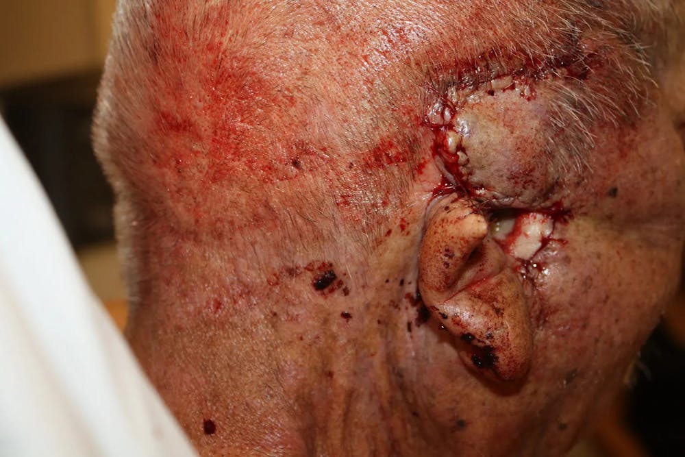 Facial and MOHS Reconstruction Before & After Gallery - Patient 5800834 - Image 3
