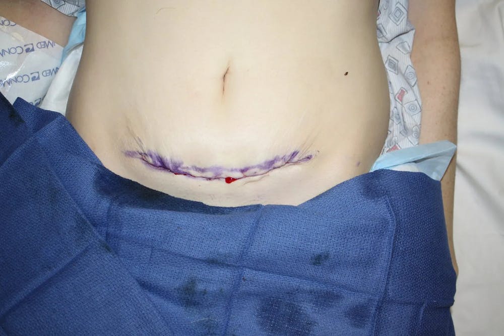 Facial and MOHS Reconstruction Before & After Gallery - Patient 5800835 - Image 2