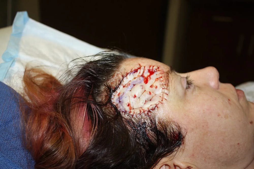 Facial and MOHS Reconstruction Before & After Gallery - Patient 5800835 - Image 3