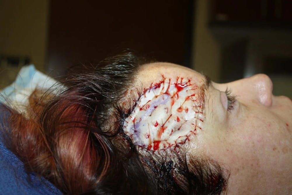 Facial and MOHS Reconstruction Before & After Gallery - Patient 5800835 - Image 5