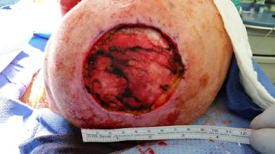 Facial and MOHS Reconstruction Before & After Gallery - Patient 5800836 - Image 2