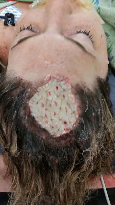 Facial and MOHS Reconstruction Before & After Gallery - Patient 5800837 - Image 2