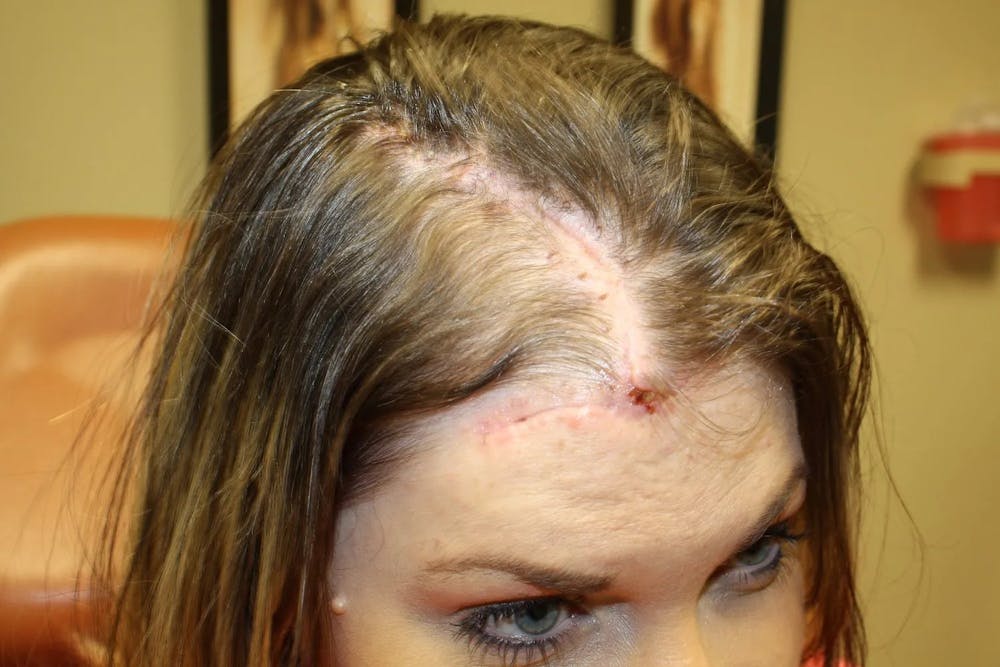 Facial and MOHS Reconstruction Before & After Gallery - Patient 5800837 - Image 4