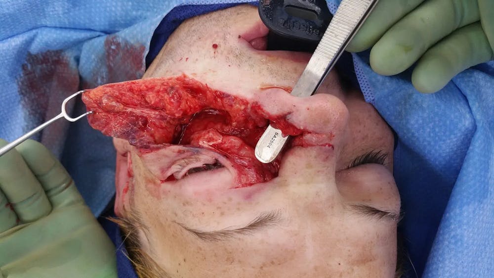 Facial and MOHS Reconstruction Before & After Gallery - Patient 5800845 - Image 1