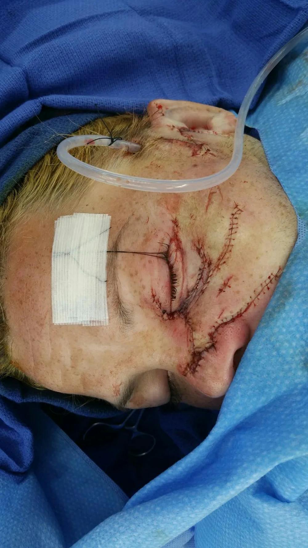 Facial and MOHS Reconstruction Before & After Gallery - Patient 5800845 - Image 2