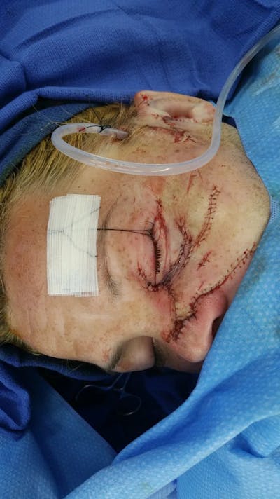 Facial and MOHS Reconstruction Before & After Gallery - Patient 5800845 - Image 2