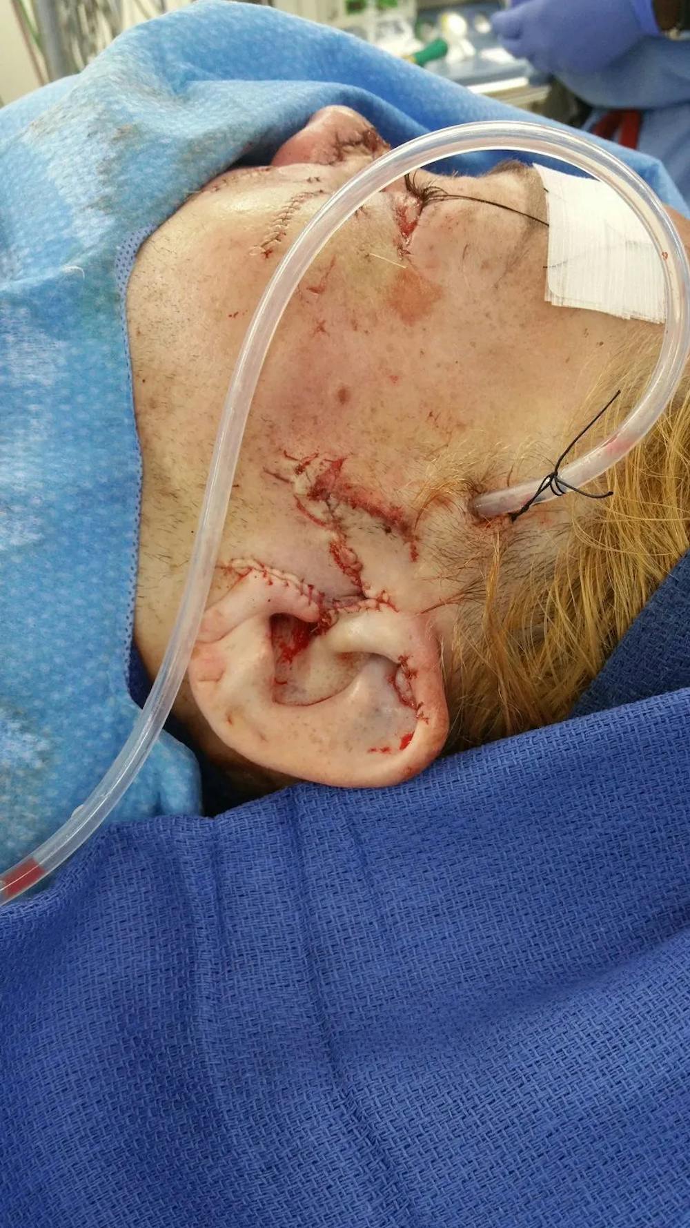 Facial and MOHS Reconstruction Before & After Gallery - Patient 5800845 - Image 3