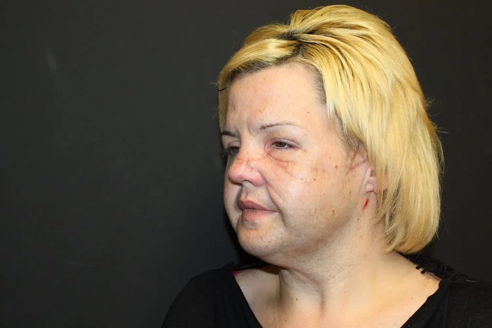 Facial and MOHS Reconstruction Before & After Gallery - Patient 5800845 - Image 5