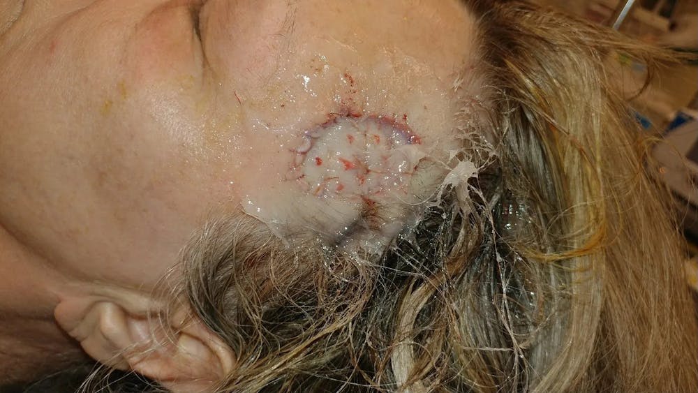 Facial and MOHS Reconstruction Before & After Gallery - Patient 5800846 - Image 2