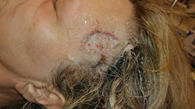 Facial and MOHS Reconstruction Before & After Gallery - Patient 5800846 - Image 2