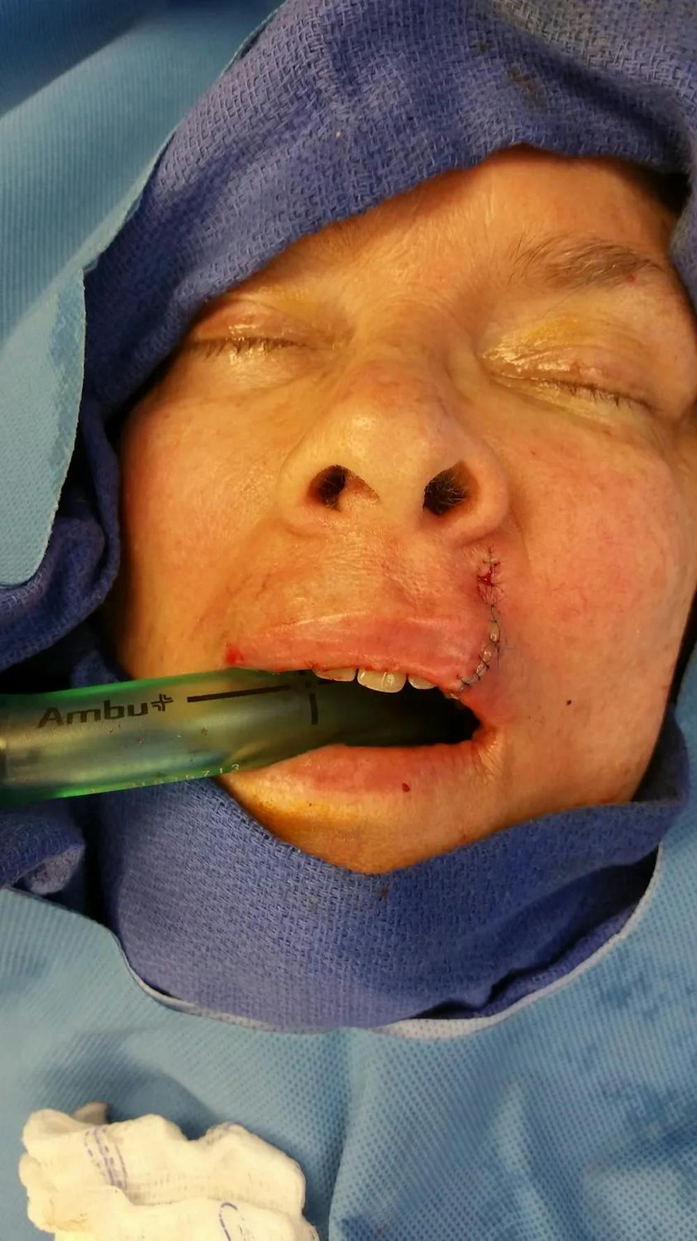 Facial and MOHS Reconstruction Before & After Gallery - Patient 5800847 - Image 2